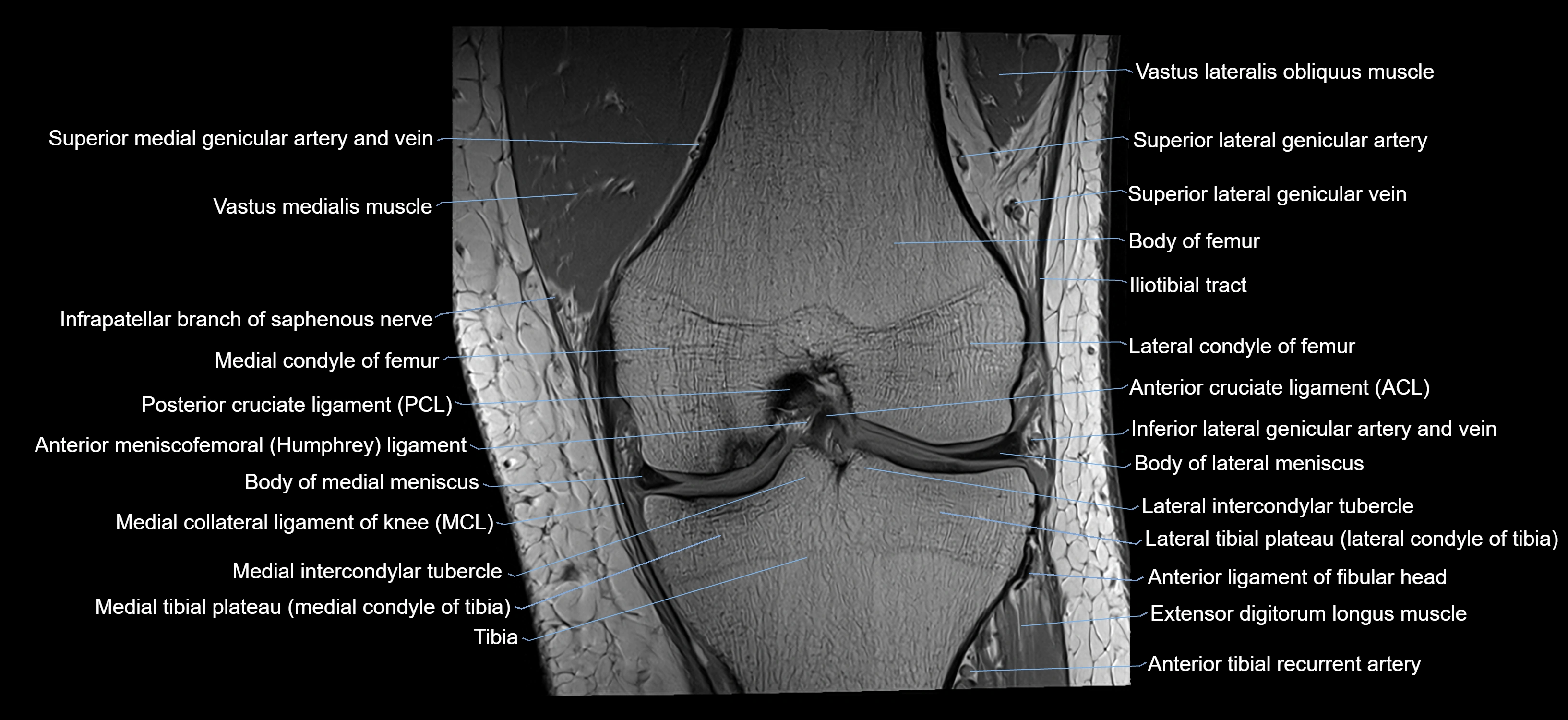 MRI knee coronal cross sectional anatomy labelled 3T radiology  image-04001-00020.webp
